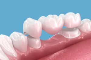 Dental Bridges Pasadena